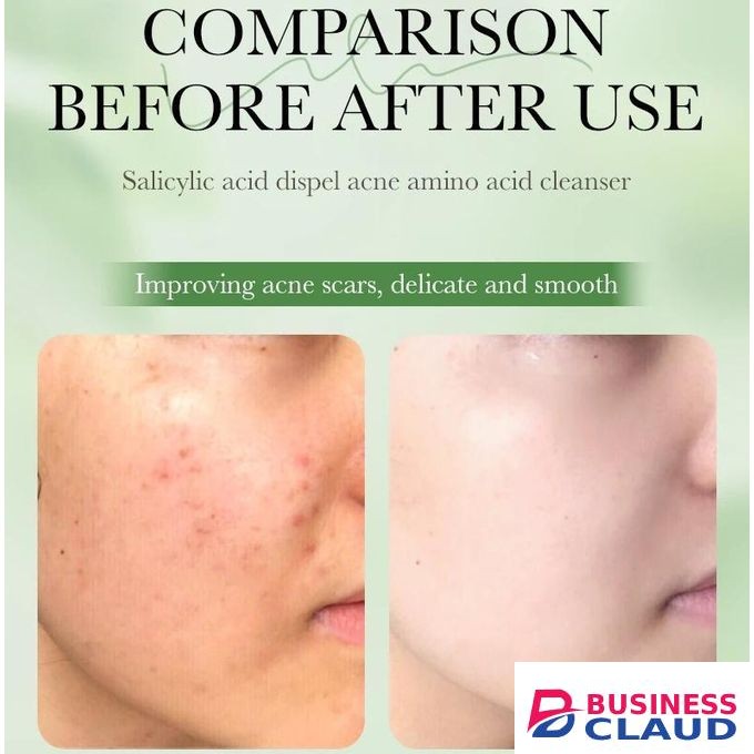 SADOER 2 in 1 Set, Acne Repair Serum+Cleanser with 3% Contains Centella Asiatica, Niacinamide and Collagen Pimples Remover,Skin Barrier Repair for Acne Prone Sensitive Skin Care,Pimple Repair Clogged Pores, Oily Skin, and Acne-Prone Skin Dispel Acne
