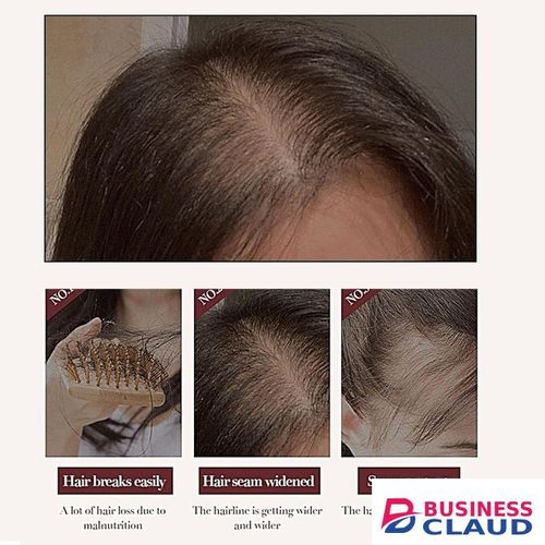 SADOER Anti Hair Loss Treatment Shampoo Essence, Hair Growth Ginger Extract Beard Growth,Hair Growth, Anti Dandruffs Hair Moisturizing Hair Care Shampoo, Derma Roller Compliment In Anti Hair Loss 500 ML