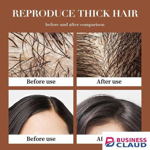 SADOER Anti Hair Loss Treatment Shampoo Essence, Hair Growth Ginger Extract Beard Growth,Hair Growth, Anti Dandruffs Hair Moisturizing Hair Care Shampoo, Derma Roller Compliment In Beard Growth 500 ML