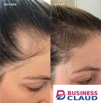 Marine Collagen Peptides Powder - Reduce Face Wrinkles, Stretchmarks & Cellulites, Promotes Healthy Hair & Nails, Enhance Skin Hydration & Texture, Supports Healthy Joints & Bones.