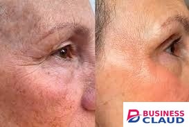 Marine Collagen Peptides Powder - Reduce Face Wrinkles, Stretchmarks & Cellulites, Promotes Healthy Hair & Nails, Enhance Skin Hydration & Texture, Supports Healthy Joints & Bones. in The-picture