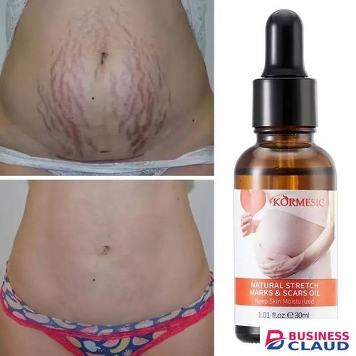 Removes Stretch Mark Oil Body,Legs Belly,Legs Stretch Marks Removal Women Repair Anti-Aging Anti-Winkles Cream Increase Elasticity Smooth Firm Skin Care - KORMESIC - in Hair-extension