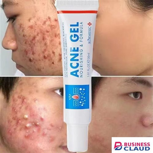 New New Powerful Acne Removal Face Cream Clears Pimple Scar Black Dots Gel Treat Severe Acne Shrink Pore Whiten Skin Care Ointment - KORMESIC - in 1-electric-hair-straightener-brush-dryer-ceramic-heating-blow-dryer-curling-iro