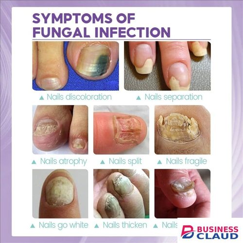 New New 100ml Toenail Fungus Care Fastacting Nail Care Liquid For Fungus Under & Around Restores The Healthy Appearance Of Nails in 1-hot-comb-straightener-electric-hair-straightener-hair-curler-wet-dry-use-hair-flat-irons-hot