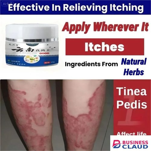 Antifungal Cream Kenya, Ringworm Treatment Cream, Athlete's Foot Solution, Jock Itch Relief, Natural Antifungal For Skin, Dermatologist-approved Skincare, Africa Fungal Infection Cream