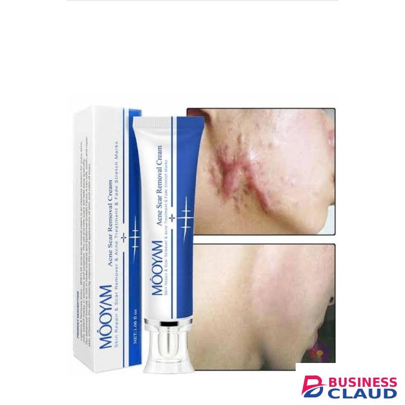 MOOYAM Acne and Scar Removal Cream
