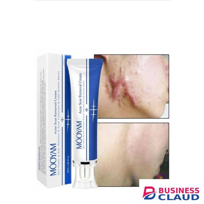 MOOYAM Acne and Scar Removal Cream