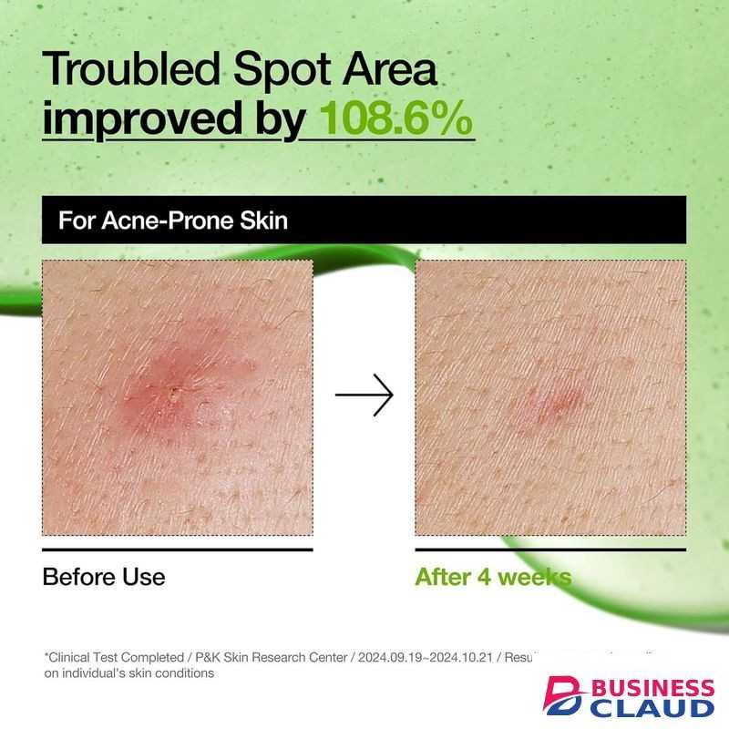 Anua Azelaic Acid 10 Hyaluron Redness Soothing Serum, Facial Serum for Sensitive skin, Hyaluronic Acid, Niacinamide, Spot Care, Natural Color, Vegan, Korean Skincare (30ml/ 1.01 fl oz.)
