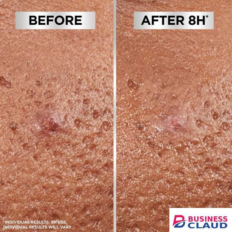 Garnier Pure Active 8hr Invisible Pimple Patch, Enriched with Hydrocolloid that Reduce Pimple Size in 8 hours - 22 pcs