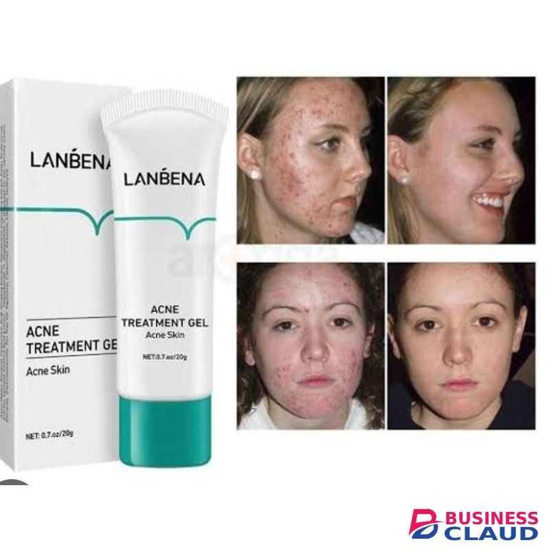 Acne Treatment Gel 20g