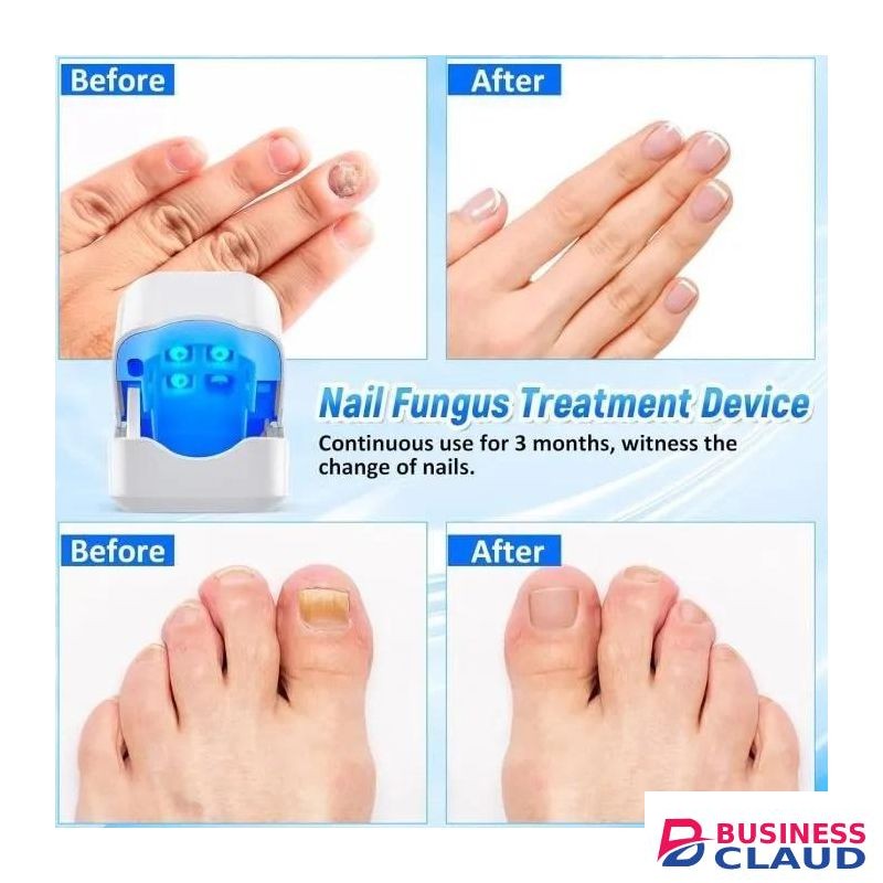 Nail Fungus Laser Treatment Device, Effective and Rechargeable Fungus Remover