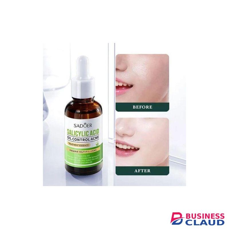 SADOER Salicylic Acid Serum For Face Shrink Pores, Gentle Exfoliating, Salicylic Acid For Anti Acne, Pimple, Spot, Blackhead Salicylic Acid Acne Treatment Essence_30ml