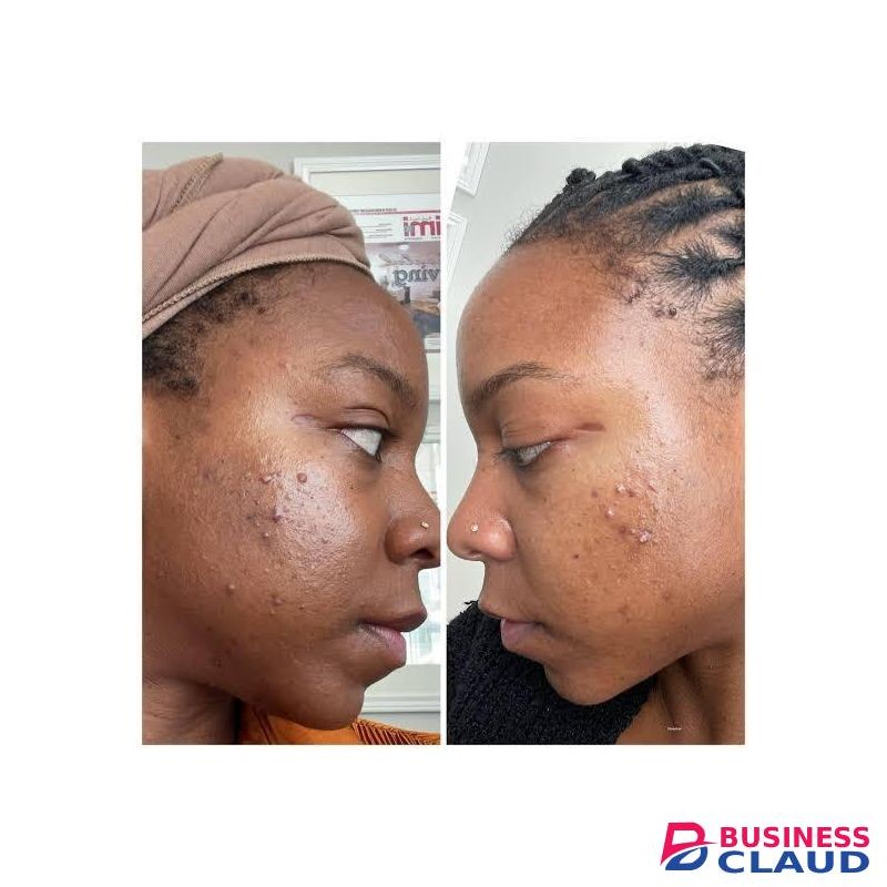 Ezanic Azelaic acid gel 20% w/w