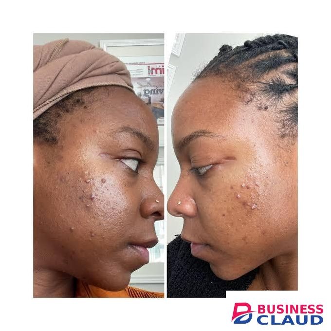 Ezanic Azelaic acid gel 20% w/w