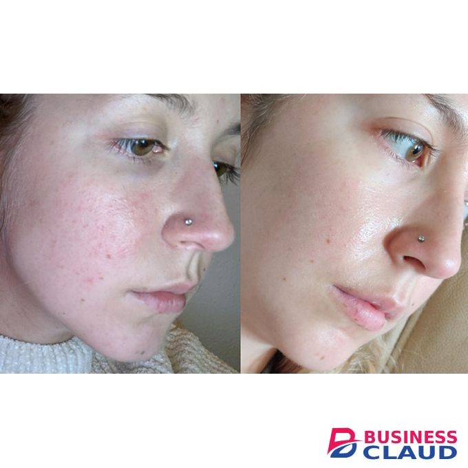 Ezanic Azelaic acid Cream 20% w/w/ Acne & Rosacea Treatment & Skin Glow