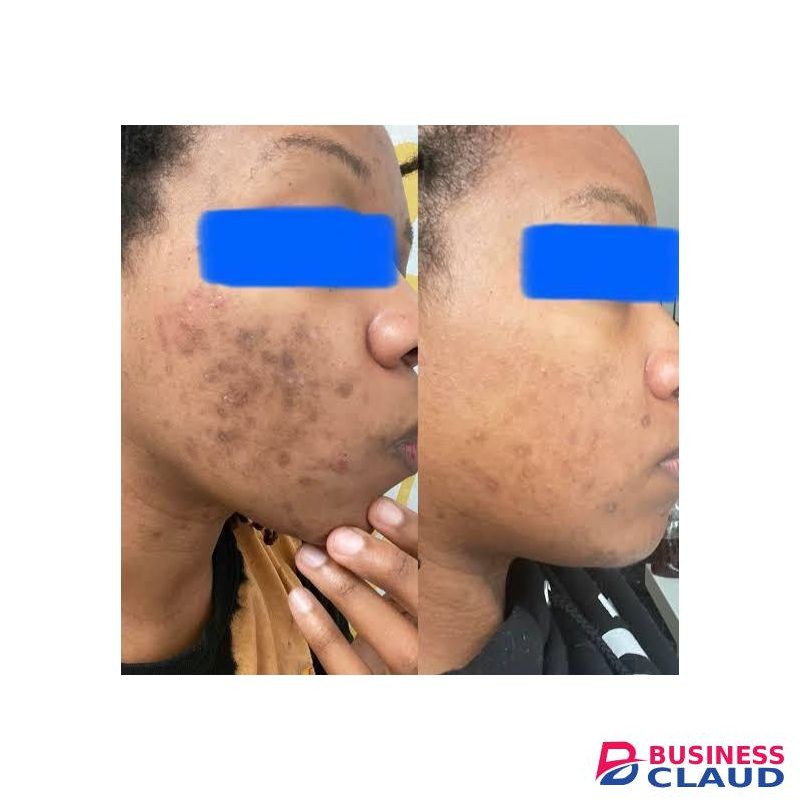 Healing Solutions Skin Brightening Demelan cream for Eczema & Dark Spots with Glycolic acid, Kojic acid & Alpha Arbutin