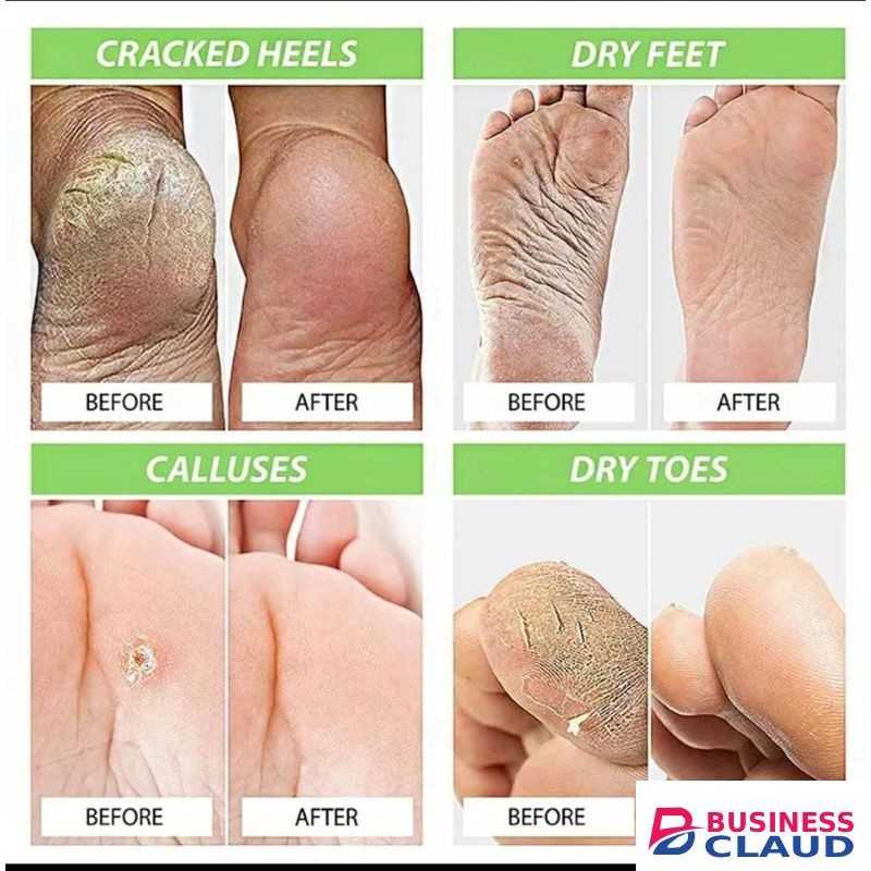 Sumifun Reliable Foot Cream - For Rough, Dry & Cracked Feet