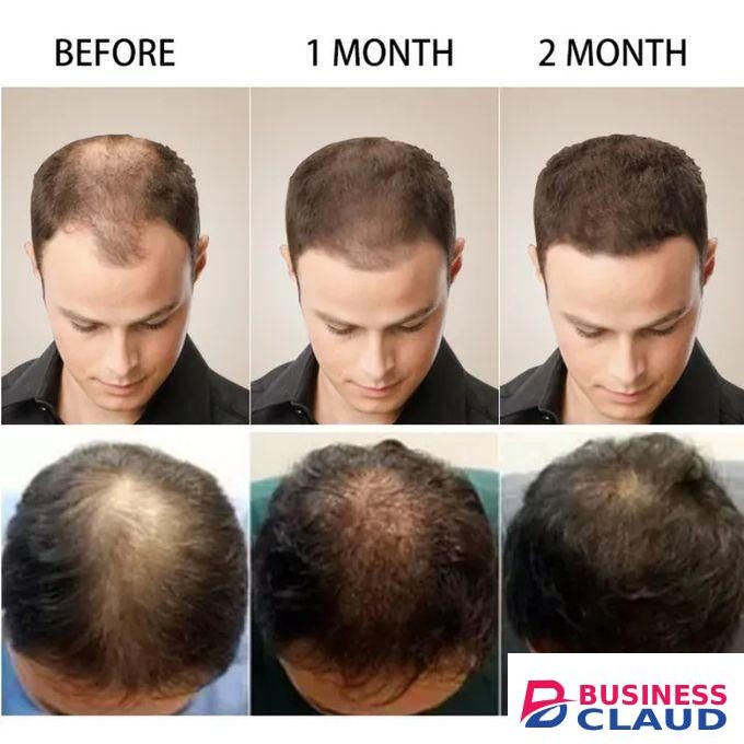 3 in 1, Ginger Hair Essence Hair Growth Serum + Ginger Anti Hair Loss + DERMAROLLER Treatment Essence Hair Growth Ginger Extract Beard Growth,Hair Growth, Anti Dandruffs Hair Moisturizing Hair Care Serum, Derma Roller Compliment In Anti Hair Loss