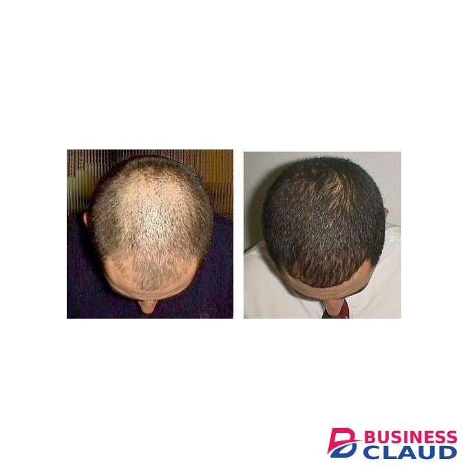 Minoxidil 2% Solution Mintop Forte Restores Hair Prevents Male Baldness