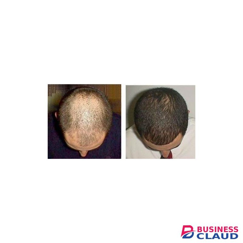 Minoxidil 2% Solution Mintop Forte Restores Hair Prevents Male Baldness