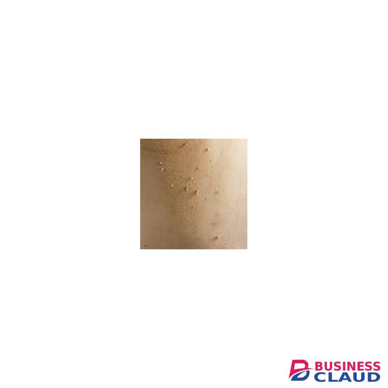 SEFUDUN Bee Venom For Warts & Moles