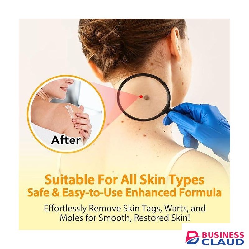 Bee Venom for Moles, Warts and Papillomas